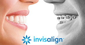 Apparecchio Invisalign